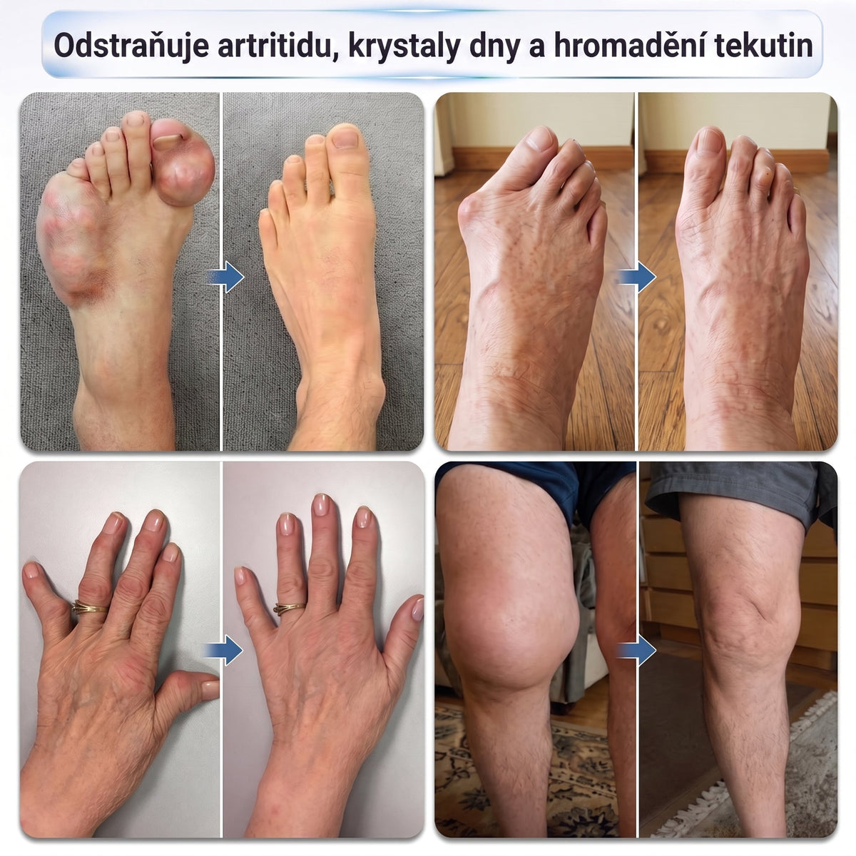OFICIÁLNÍ OBCHOD | IFMAGIC® 0,05 mm Mikroneedle Rychle Působící Roll-On pro Úlevu Kloubů a Kostí🔥