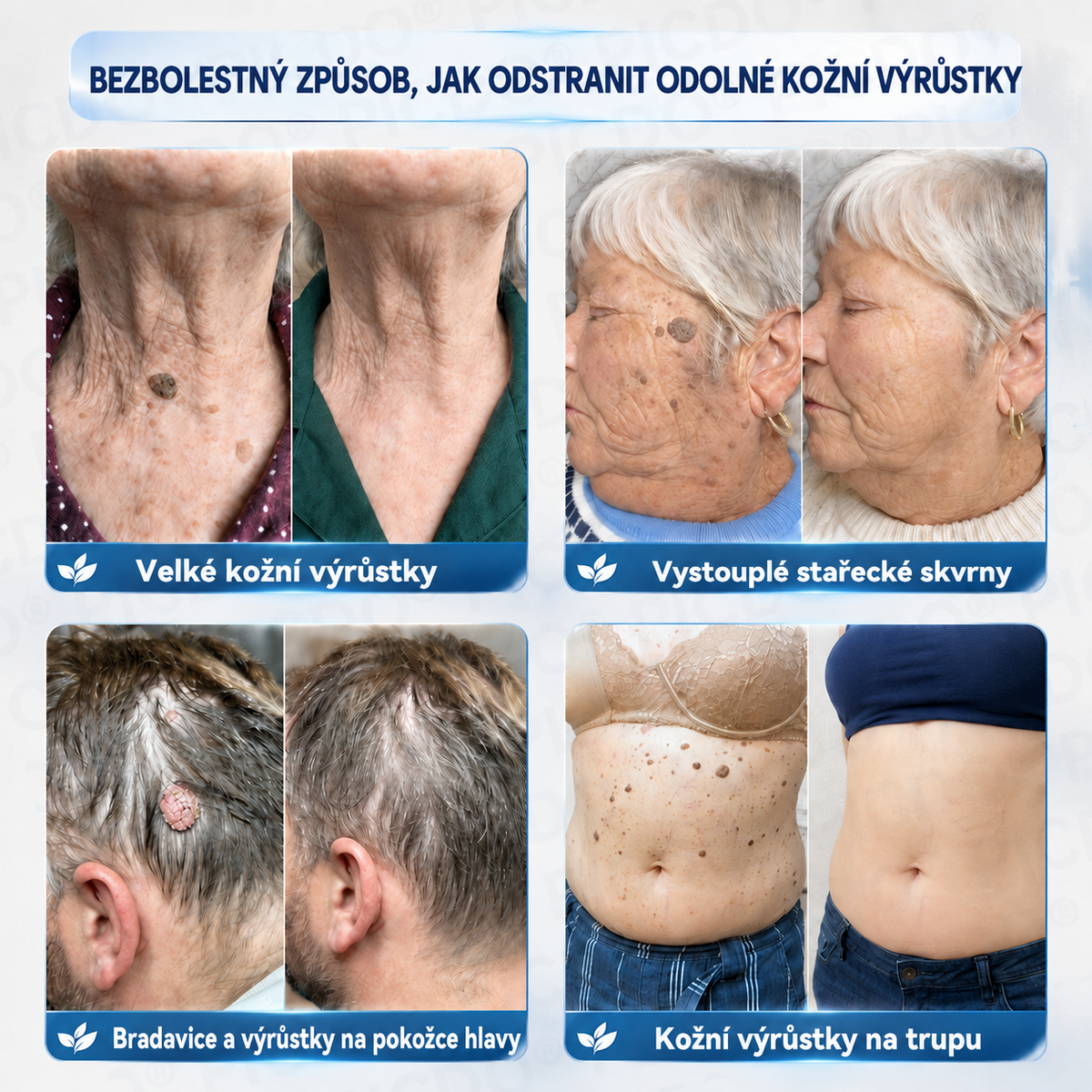 Picdo® 7‑denní krém k odstraňování kožních výrůstků a pigmentových skvrn 🧴(𝐒𝐜𝐡𝐦𝐞𝐫𝐳𝐟𝐫𝐞𝐢𝐞 𝐅𝐨𝐫𝐦𝐞𝐥 – 𝐨𝐡𝐧𝐞 𝐍𝐚𝐫𝐛𝐞𝐧) 💪