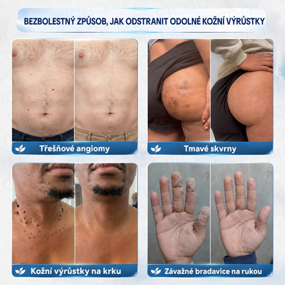 Picdo® 7‑denní krém k odstraňování kožních výrůstků a pigmentových skvrn 🧴(𝐒𝐜𝐡𝐦𝐞𝐫𝐳𝐟𝐫𝐞𝐢𝐞 𝐅𝐨𝐫𝐦𝐞𝐥 – 𝐨𝐡𝐧𝐞 𝐍𝐚𝐫𝐛𝐞𝐧) 💪