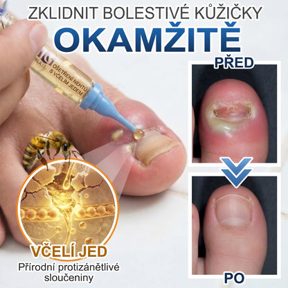 🇪🇺 Certyfikowany w UE 👩‍🔬 CareBreeze® Fungi Free – Intensywna Kuracja do Paznokci na Bazie Jadu Pszczelego ✨