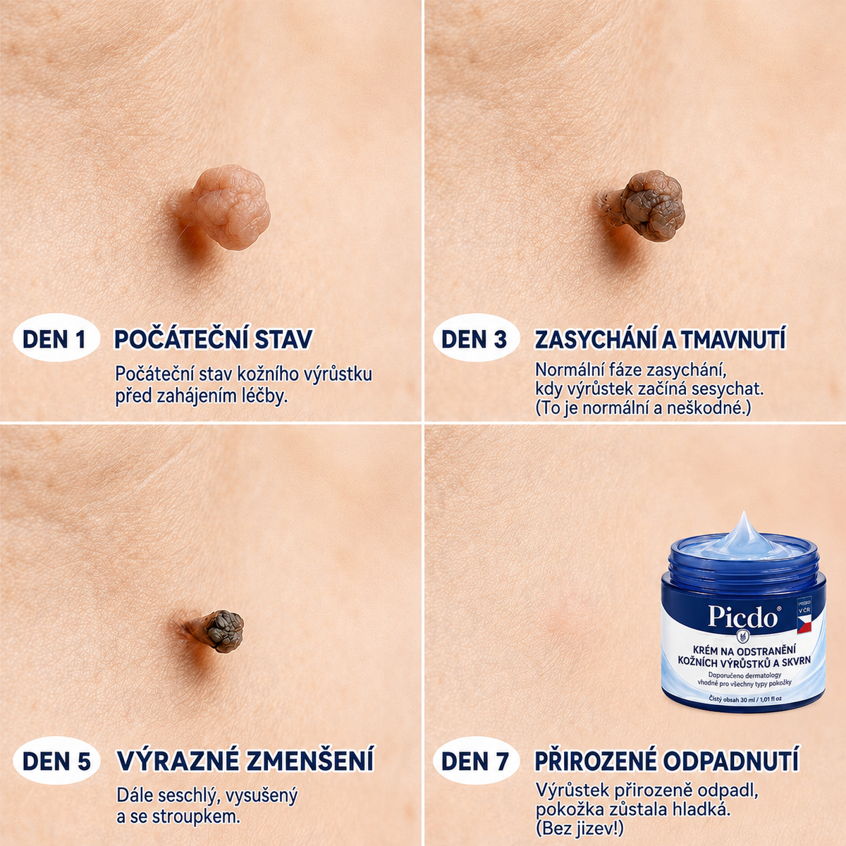 Picdo® 7‑denní krém k odstraňování kožních výrůstků a pigmentových skvrn 🧴(𝐒𝐜𝐡𝐦𝐞𝐫𝐳𝐟𝐫𝐞𝐢𝐞 𝐅𝐨𝐫𝐦𝐞𝐥 – 𝐨𝐡𝐧𝐞 𝐍𝐚𝐫𝐛𝐞𝐧) 💪
