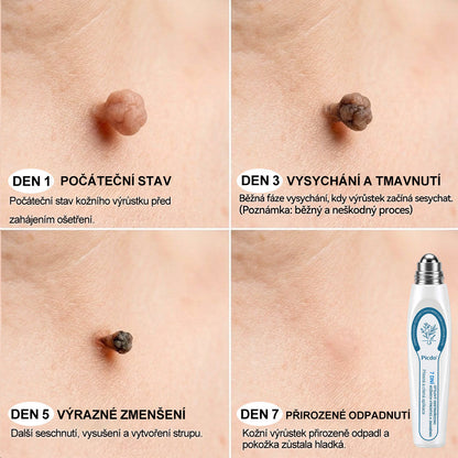 Oficiální značkový obchod |👩‍⚕️𝐏𝐢𝐜𝑑𝑜® 𝟩𝖽𝖾𝗻𝗻í 𝘰𝘥𝘴𝘵𝗋𝖺ň𝗈𝗏𝖺č 𝒔𝒌𝒗𝒓𝙣 𝙖 𝙥𝙞𝙜𝙢𝙚𝙣𝙩𝘰𝘷ý𝘤𝘩 𝘴𝘬𝖛𝖗𝖓 (Bezbolestný rollerball bez jizev)✨